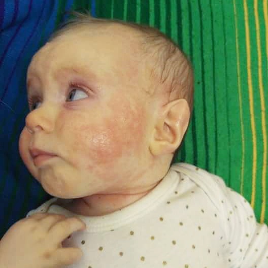 Dermatite atopica neonato, Acneea bebelușului. Cum o deosebești de dermatita atopică?